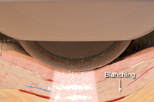 Animation of a class IV therapy laser