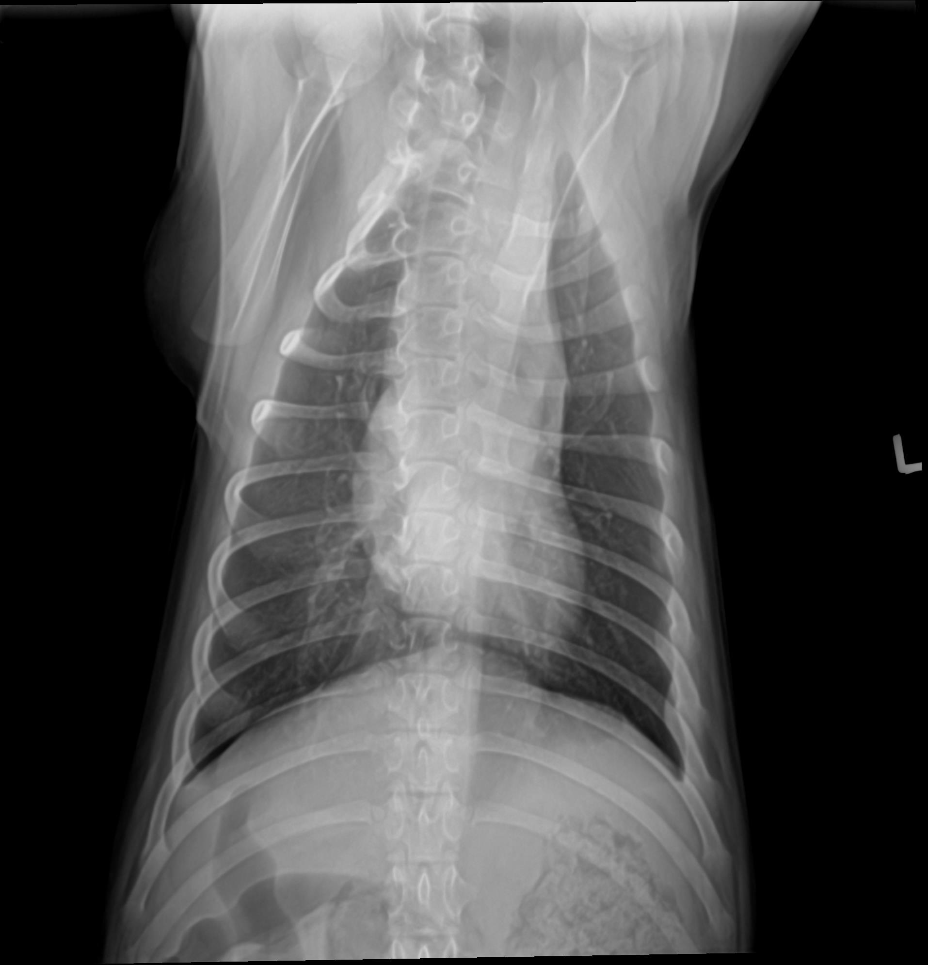 Moe Pnumonia Radiograph After Laser Therapy ThoraxVD2.10.26